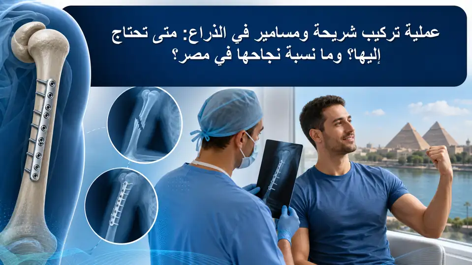 عملية تركيب شريحة ومسامير في الذراع: متى تحتاج إليها؟ وما نسبة نجاحها في مصر؟