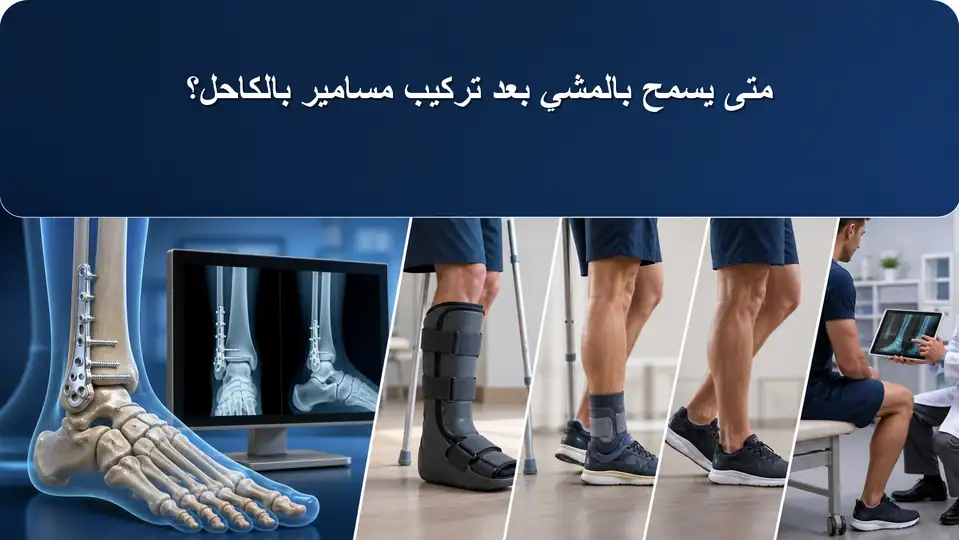 متى يسمح بالمشي بعد تركيب مسامير بالكاحل؟