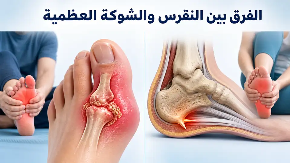 ما هو الفرق بين النقرس والشوكة العظمية؟